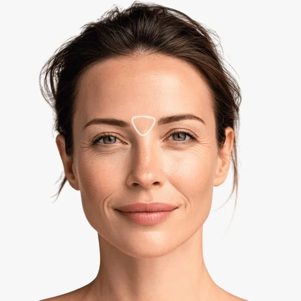 Zornesfalte Behandlung mit Botox®